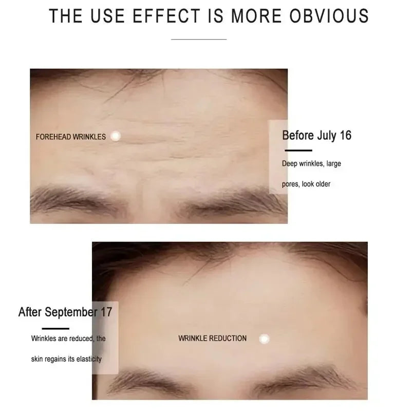 GlowUp™ - Patch Effet Botox 8h - Anti-Rides Front Collagène