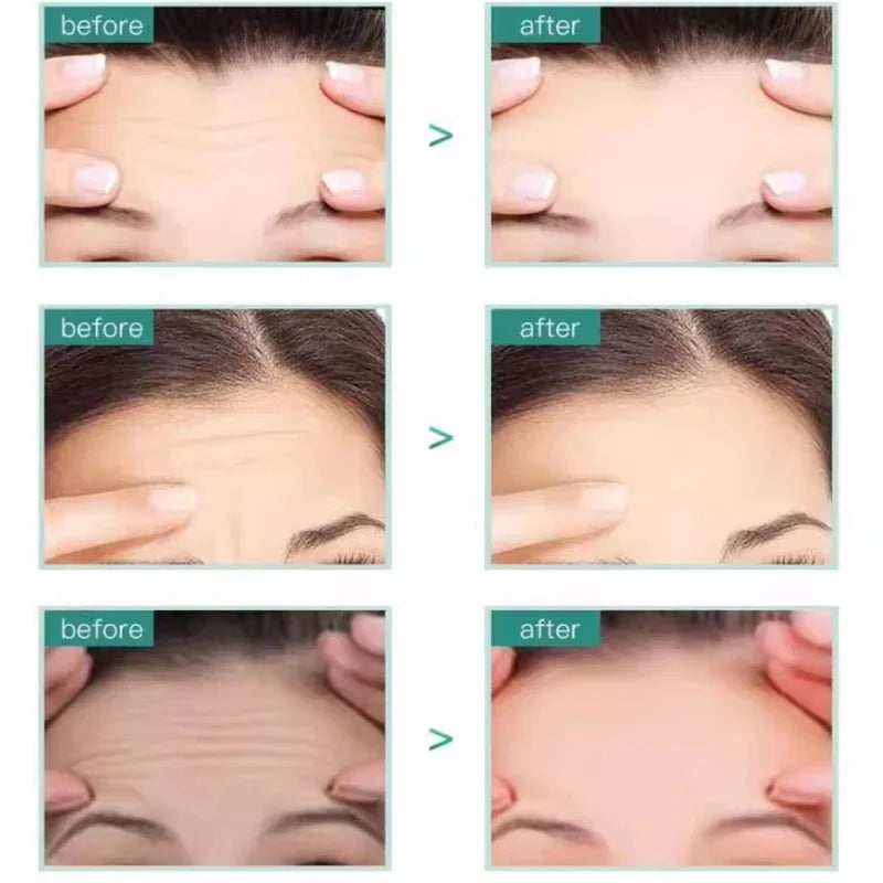GlowUp™ - Patch Effet Botox 8h - Anti-Rides Front Collagène